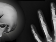 salud osteoporosis